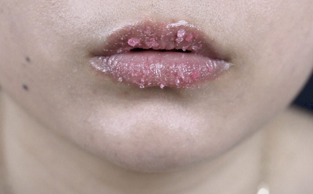 Close-up of chapped and peeling lips on a person's face.