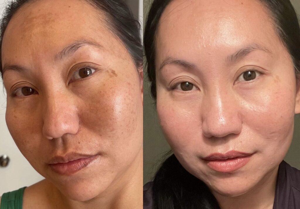 Before and after skincare treatment showing improved skin tone and texture.